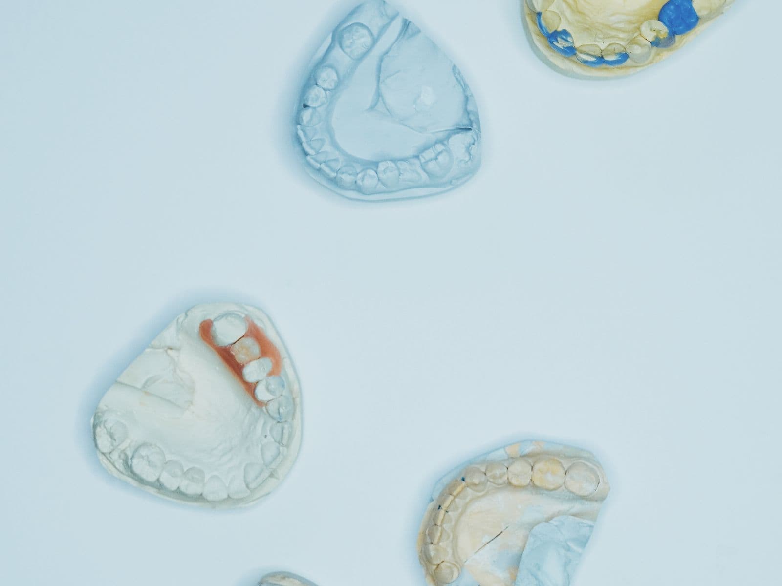 Custom-made dental casts used to craft dentures